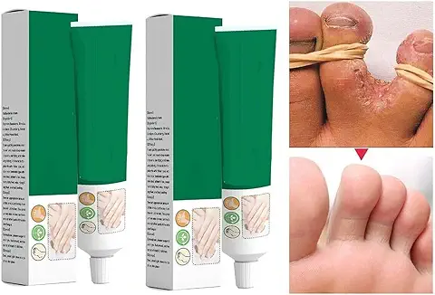 ZODUSTT Crema para Eliminar Lo Hongo En Los Pies Alivia la Picazon Y Luce Pies Radiantes, Cuidado de pies (2 Piezas)  